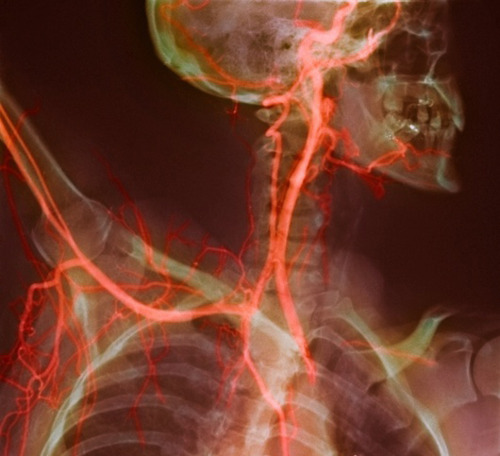 Neck and shoulder arteries, X-ray